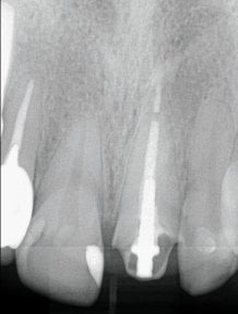 before-after photo dental-implant