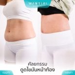 Efekty liposukcji brzucha przed i po w Wansiri Hospital – smuklejsza talia