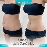 Результаты липосакции живота до и после в Wansiri Hospital, более стройная талия