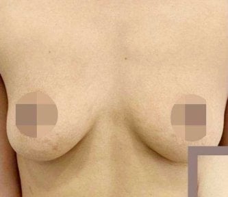 Przed powiększaniem piersi w klinice – naturalny kształt przed zabiegiem