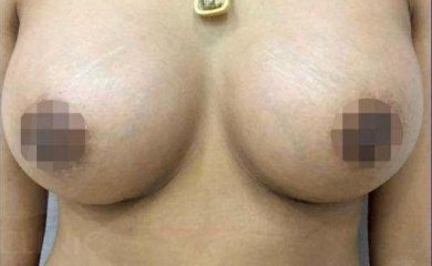 Efekt powiększania piersi – pełniejsze, naturalnie wyglądające piersi po zabiegu