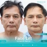 Результаты до и после фейслифтинга и подтяжки шеи в Wansiri Hospital, омоложение лица