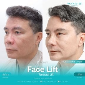 Результаты до и после фейслифтинга в Wansiri Hospital, временной лифтинг лица