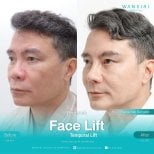 Результаты до и после фейслифтинга в Wansiri Hospital, временной лифтинг лица