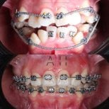 Before and after braces results at CIVICO DENTAL CARE MEXICALI, visible teeth alignment improvement