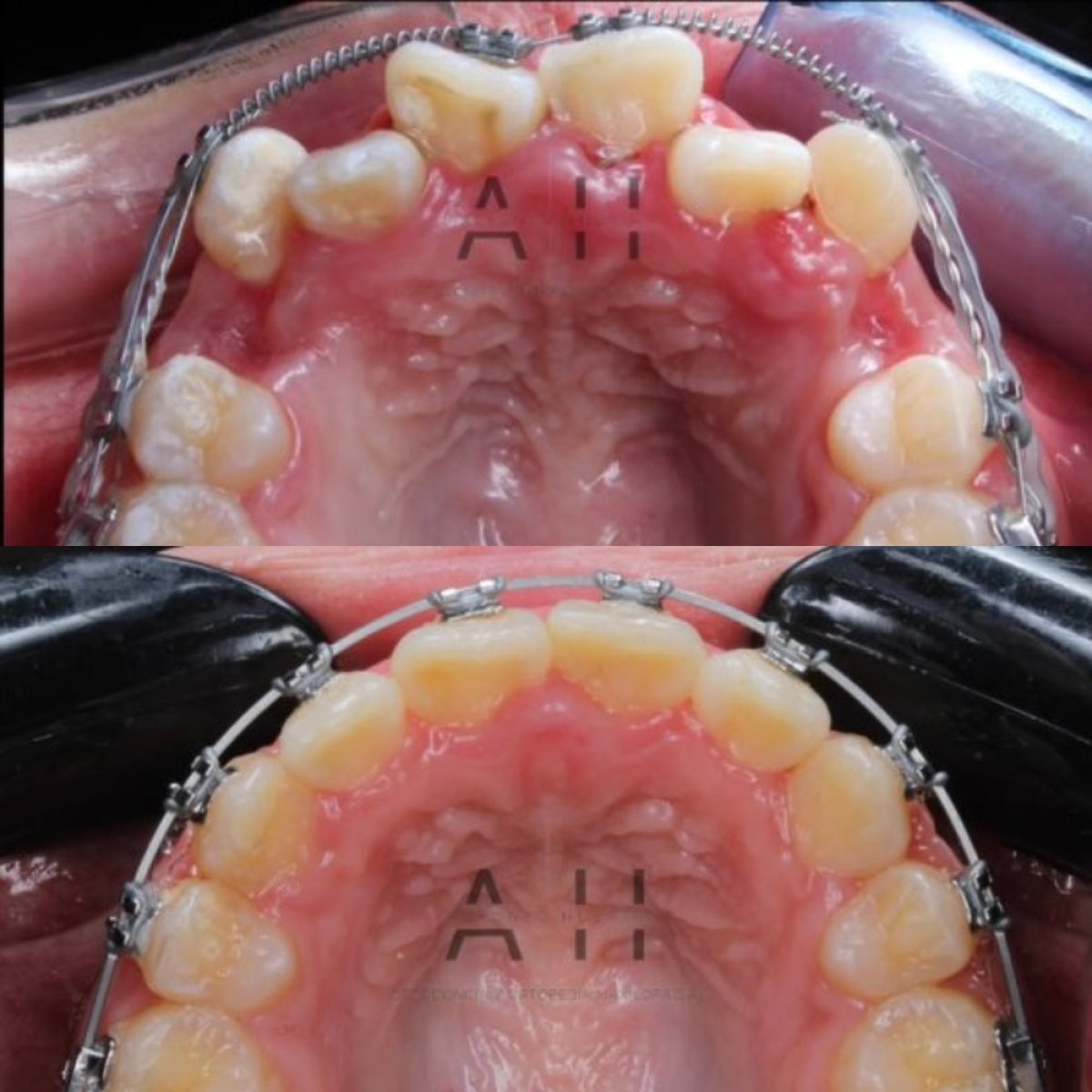 نتائج قبل وبعد تقويم الأسنان في CIVICO DENTAL CARE MEXICALI، تحسين اصطفاف الأسنان