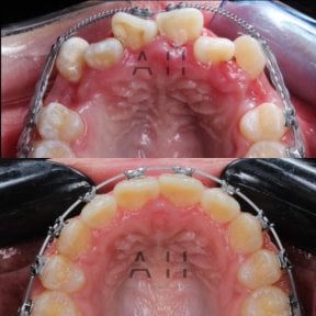Before and after braces results at CIVICO DENTAL CARE MEXICALI, improved teeth alignment