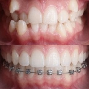Before and after braces results at CIVICO DENTAL CARE MEXICALI, teeth alignment improvement
