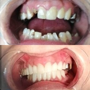 Результаты до и после имплантации зубов в CIVICO DENTAL CARE MEXICALI, восстановленная улыбка