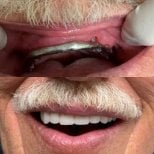 До и после результата имплантации All-on-4 в CIVICO DENTAL CARE MEXICALI, улучшенная улыбка