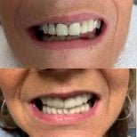 Before and after denture results at CIVICO DENTAL CARE MEXICALI – improved smile transformation