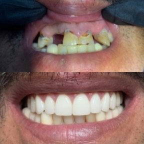 Before and after denture results at CIVICO DENTAL CARE MEXICALI, restored smile transformation