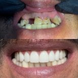 Before and after denture results at CIVICO DENTAL CARE MEXICALI, restored smile transformation
