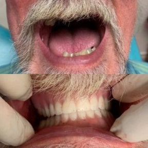 Before and after denture results at CIVICO DENTAL CARE MEXICALI, restored full smile