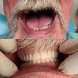Before and after denture results at CIVICO DENTAL CARE MEXICALI, restored full smile
