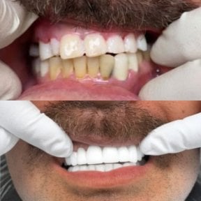 Before and after denture results at CIVICO DENTAL CARE MEXICALI, improved smile transformation