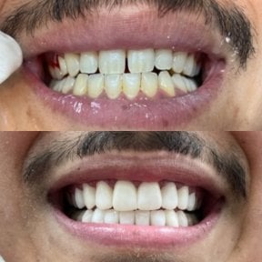 Before and after denture results at CIVICO DENTAL CARE MEXICALI, improved smile aesthetics
