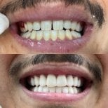 Before and after denture results at CIVICO DENTAL CARE MEXICALI, improved smile aesthetics