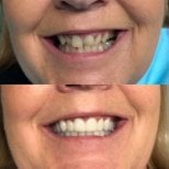 Before and after denture results at CIVICO DENTAL CARE MEXICALI, improved smile transformation