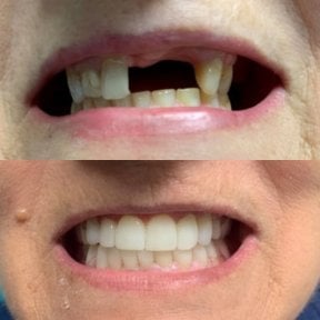 Before and after denture results at CIVICO DENTAL CARE MEXICALI – restored smile transformation