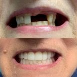 Before and after denture results at CIVICO DENTAL CARE MEXICALI – restored smile transformation