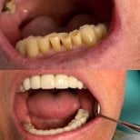 Before and after denture results at CIVICO DENTAL CARE MEXICALI, improved smile and function