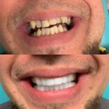 Before and after denture results at CIVICO DENTAL CARE MEXICALI – improved smile transformation