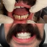 Before and after denture results at CIVICO DENTAL CARE MEXICALI, improved smile transformation