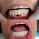 Before and after denture results at CIVICO DENTAL CARE MEXICALI – improved smile restoration