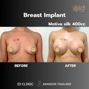 Результаты до и после увеличения груди имплантами Motiva 400cc в ID Clinic Bangkok