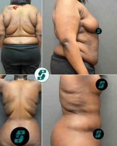 before-after photo abdominoplasty