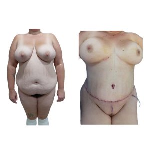 before-after photo abdominoplasty
