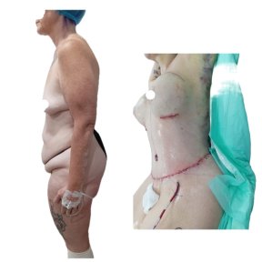 before-after photo abdominoplasty