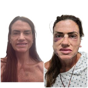 before-after photo deep-plane-facelift