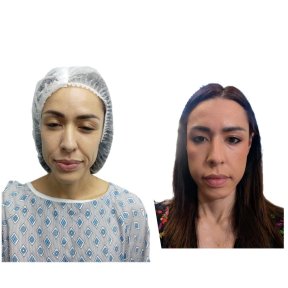 before-after photo deep-plane-facelift