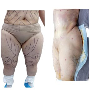 before-after photo thigh-lift