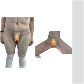 before-after photo thigh-lift