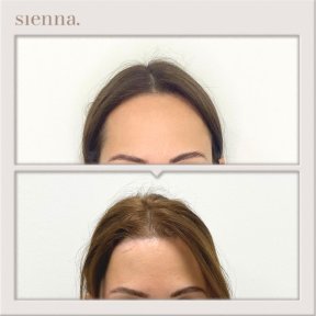before-after photo lifting-lba
