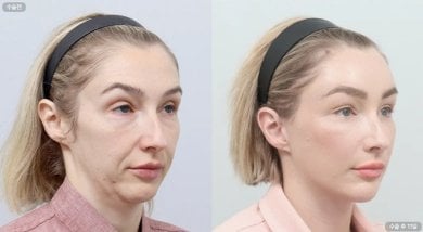 Facelift before and after results at AB Plastic Surgery – visible facial rejuvenation outcome