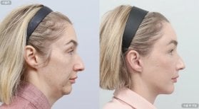 Facelift before and after results at AB Plastic Surgery, visible jawline and neck improvement