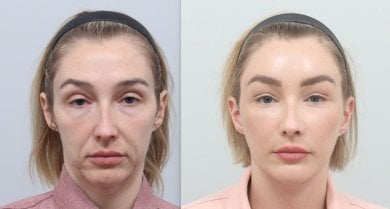Before and after facelift results at AB Plastic Surgery, visible facial rejuvenation and lift