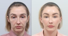 Before and after facelift results at AB Plastic Surgery, visible facial rejuvenation and lift
