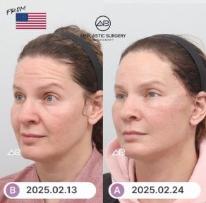 Before and after facelift results at AB Plastic Surgery – visible facial rejuvenation