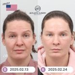 Facelift before and after results at AB Plastic Surgery – visible facial rejuvenation