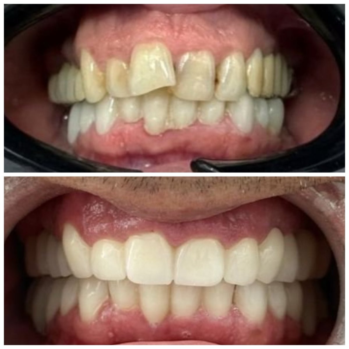 نتائج قبل وبعد تركيب تيجان الأسنان في Santa Caterina Clinic Dental & Aesthetic Medicine