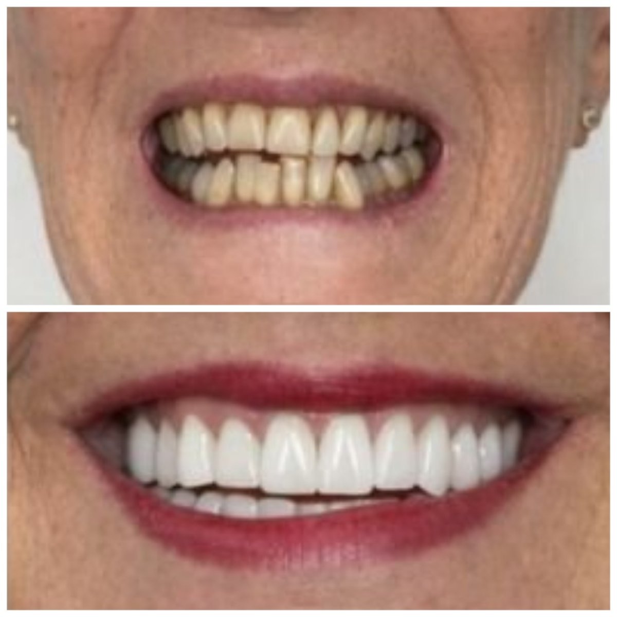 Resultado antes y después de la colocación de coronas dentales en Santa Caterina Clinic Dental & Aesthetic Medicine