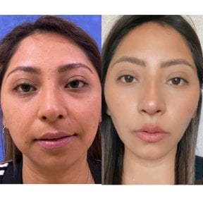 before-after photo glubokaya-podtyazhka-lica-deep-plane-facelift