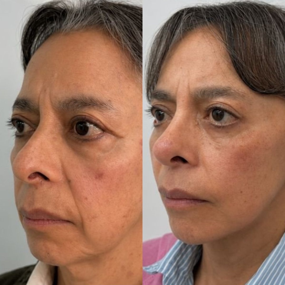 Before and after deep plane facelift result at Lucio Santos Plastic Surgery, facial rejuvenation