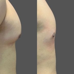 before-after photo vaser-liposakcia