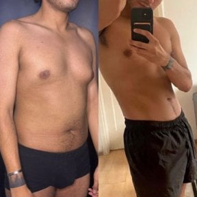 before-after photo vaser-liposakcia
